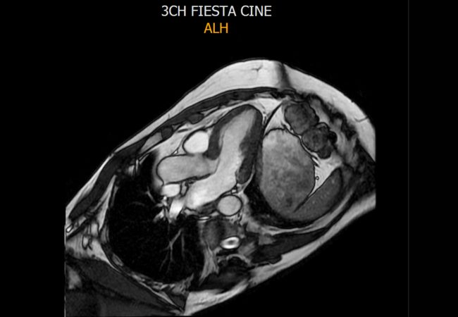 Cardiac Magnetic Resonance (cvi42)