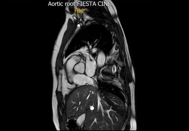 Cardiac Magnetic Resonance (cvi42)